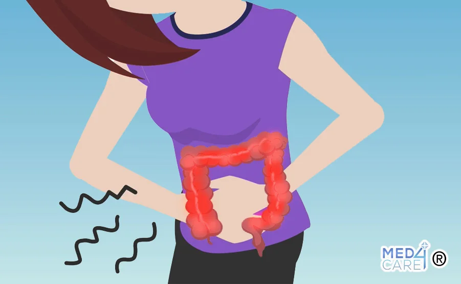 colon irritabile